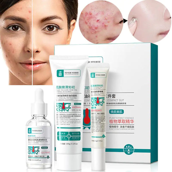 New Antiques Anti Acne Removal Moisturizing Face Skin Care Kit